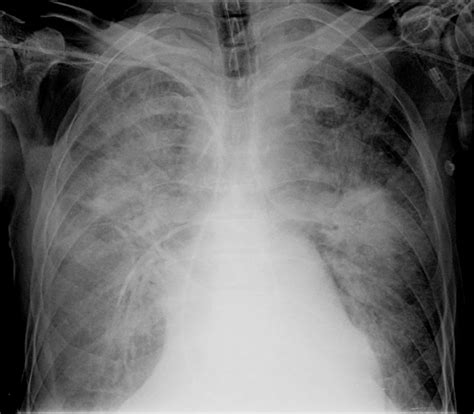 Radiografia De Edema Pulmonar Image To U
