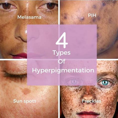 Post Inflammatory Hyperpigmentation Causes Treatments And Prevention