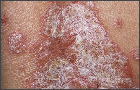 Plaque Psoriasis Pictures Psoriasis Expert