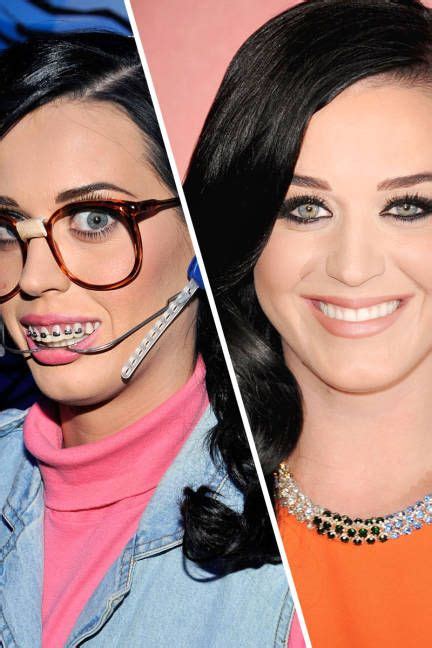 Katy Perry With Braces Celebrities Who Had Braces Braces Before And After After Braces