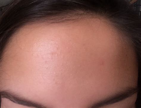 Small Red Bumps On Forehead