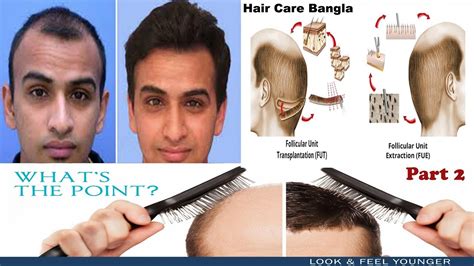 Hair Transplant Process Fue And Fut Explain About Side Effects Part