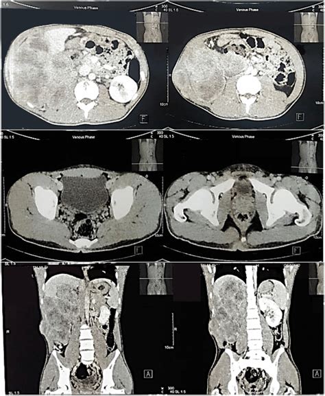 Abdominal Computed Tomography R1 Before Chemotherapy Download