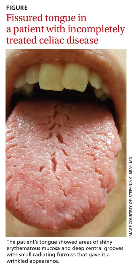 Probiotics For White Tongue Captions Trendy