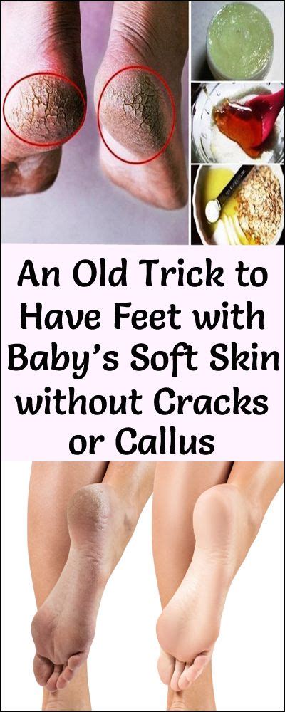 An Old Trick To Have Feet With Babys Soft Skin Without Cracks Or