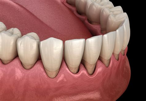 Gum Disease Periodontal Disease Treatment Sound Dental