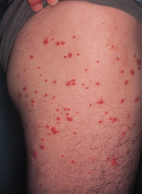 Pruritic Urticarial Papules Of The Thighs And Groin Allergy And