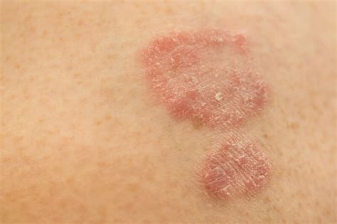 Are Allergies Causing Your Skin Sensitivity Vibrance Medspa