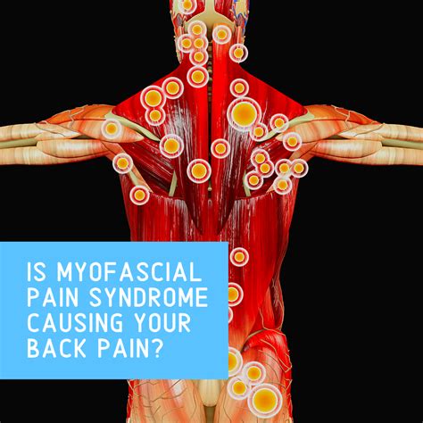Is Myofascial Pain Syndrome Causing Your Back Pain New Jersey