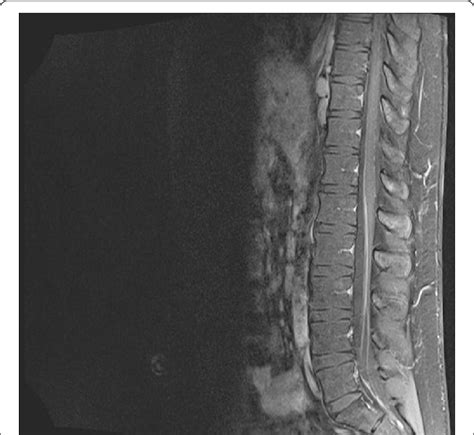 Mri Of The Cauda Equina Enhancing Lesions Of The Nerve Roots Are Seen