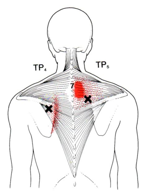 Pin On Health Myofascial Release Trigger Point