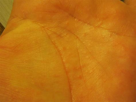 4 Outbreaks Of Small Itchy Bumps Not Red On Palms And Back Of Hands