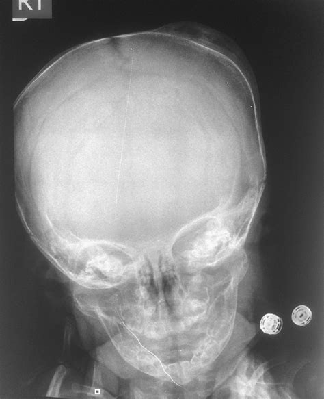 Calcified Cephalohaematoma Radiology Case