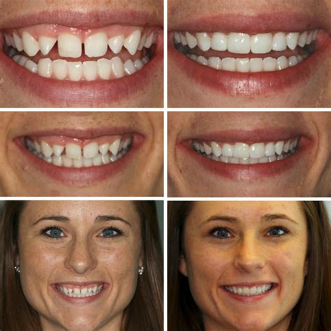 Invisalign Invisible Braces At Dentistry By Design In Columbia Mo