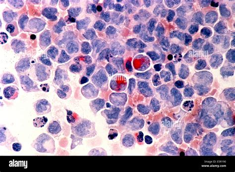 Photomicrograph Of Human White Blood Cells With Acute Myelocytic
