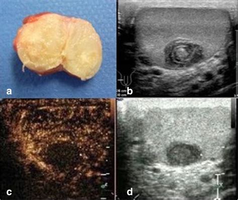Testicular Epidermoid Cysts A Reevaluation Abstract Europe Pmc