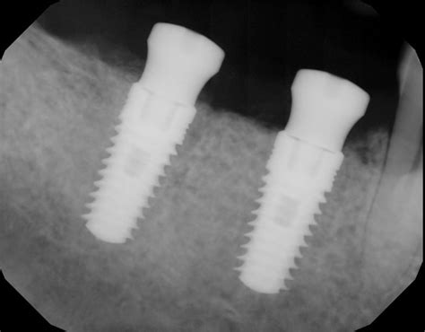 Is It Normal Extraction Bone Graft White Membrane Showing Ramsey