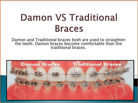 PPT Reasons Why Damon Braces Are Differing To The Traditional Braces