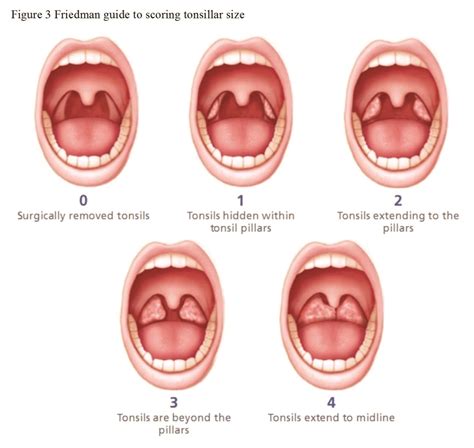 Hypertrophic Tonsils