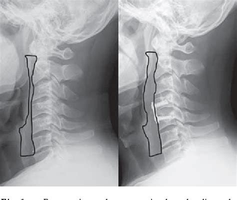 Figure 1 From Effect Of Intravenous Dexamethasone On Prevertebral Soft