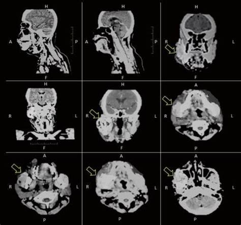 Ct Scan Imaging Showed Submandibular Abscess With Expansion To Right