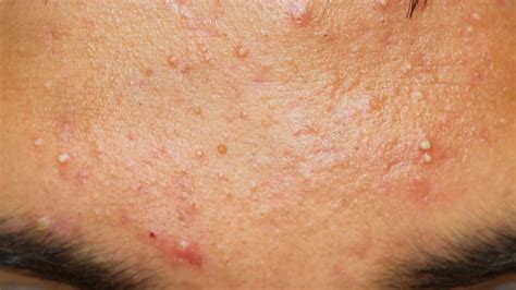 Mild Acne Vulgaris