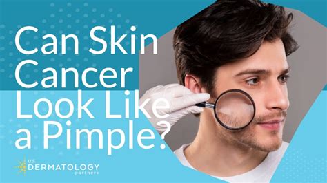 Can Skin Cancer Look Like A Pimple Youtube