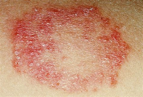 An overgrowth of the fungus candida is the cause of yeast infections. Slideshow: Fungal Skin Infections -- Prevention and Treatment