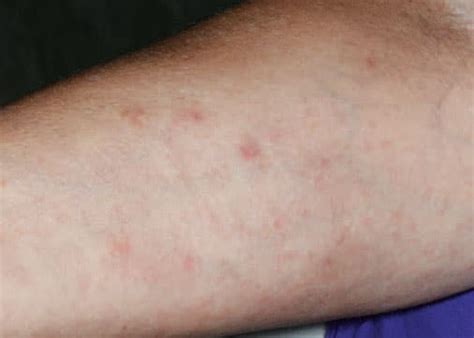 Managing Severe Delayed Cutaneous Allergic Drug Reactions