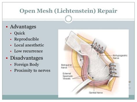 Laparoscopic Vs Open Inguinal Hernia Repair