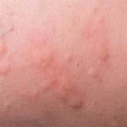 8 Common Causes Of An Itchy Rash