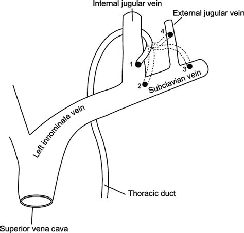 Left Subclavian Vein Thoracic Duct