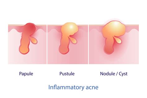 Pustule Pimple