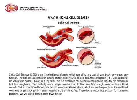 What Is Sickle Cell Disease By Tamara Mannix Issuu