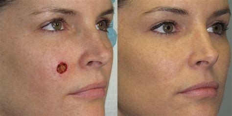 Cheek Reconstruction Gallery Skin Cancer And Reconstructive Surgery