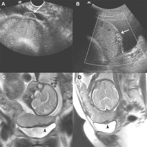 Anterior Placenta On Ultrasound