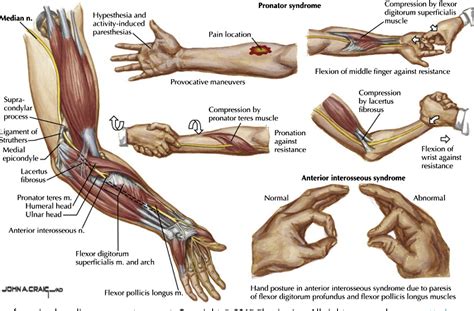 Figure 1 From Diagnosis And Treatment Of Work Related Proximal Median