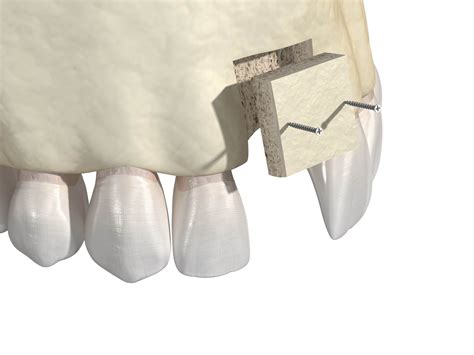 Bone Grafting Summit Dental Health