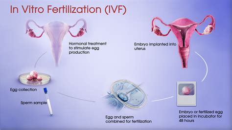 In Vitro Fertilization Ivf Process And Embryo Transfer