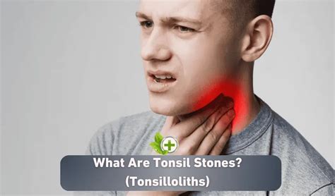 What Are Tonsil Stones Tonsilloliths Ulti Health Guide
