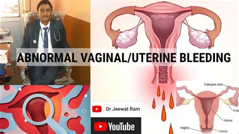 Causes And Diagnosis Of Abnormal Vaginal Bleeding My Xxx Hot Girl