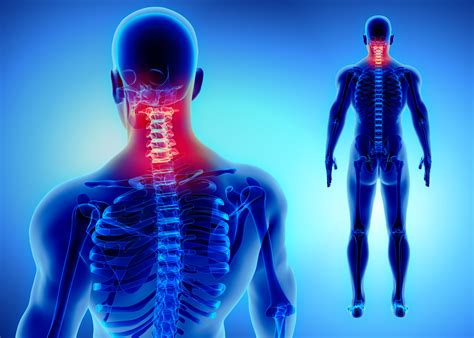 What Is Cervical Radiculopathy Radiculopathy Cervical Radiculopathy
