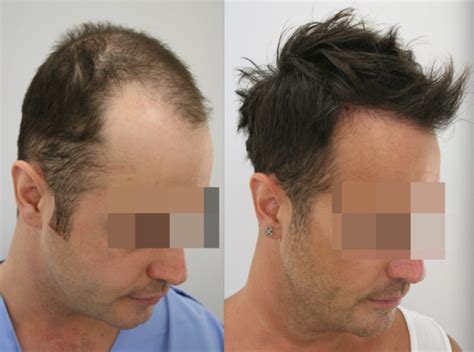 Hair Transplant Turkey From £1199 Free Consultation In Uk Gethair