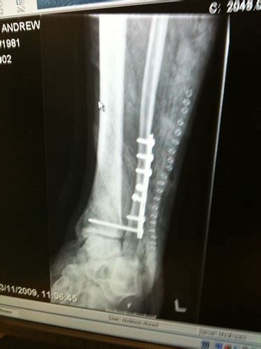 I had surgery and have a metal rod and screws put in. Broken leg / ankle... :( - Runners Forum