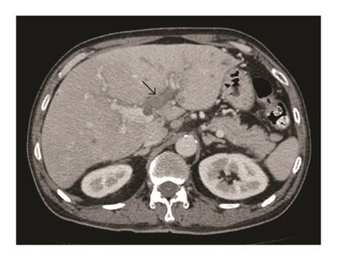 Axial Computed Tomography Ct Scan Portal Venous Phase Shows