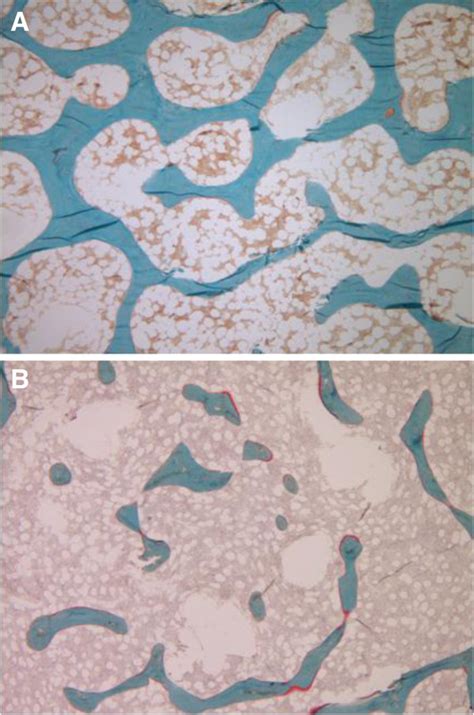 Bone Biopsy Goldnerstrichrome Magnification 40x Showing In Red The