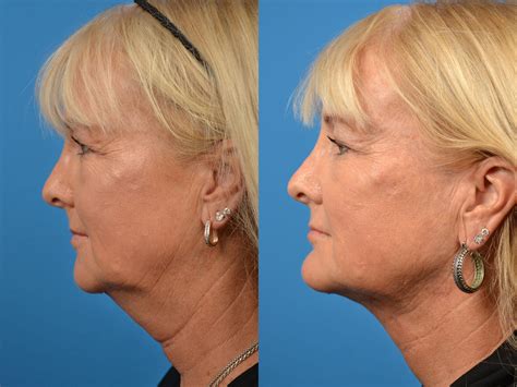 laser assisted weekend neck lift photos melbourne fl patient 56652