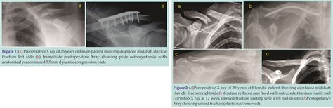 Surgical Fixation Of Displaced Mid Shaft Clavicle Fractures Elastic