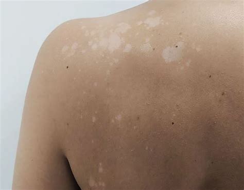 An Overview Of Tinea Versicolor Causes Symptoms And Effective Treatments