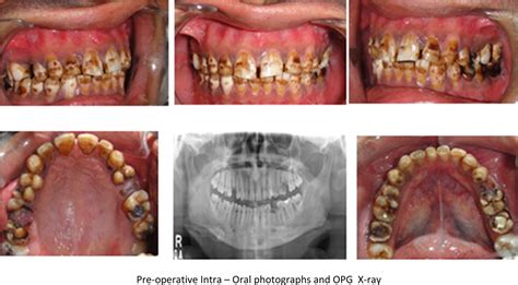 Clinical Management Of Severe Fluorosis In An Adult Bmj Case Reports